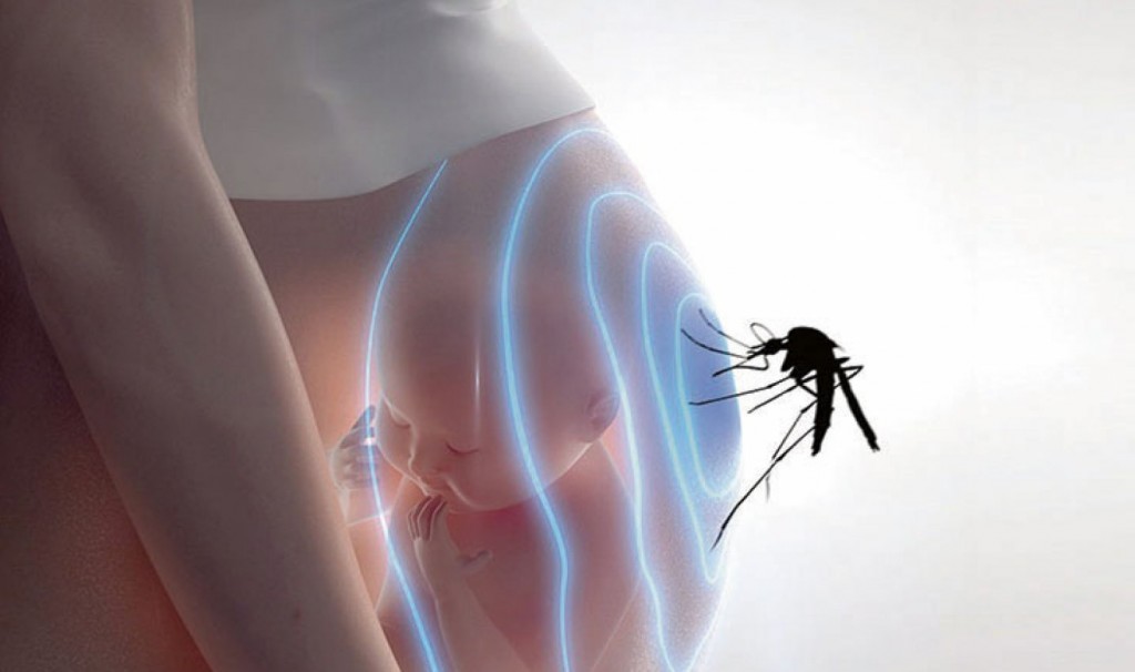 El zika podría causar microcefalia en los neonatos 