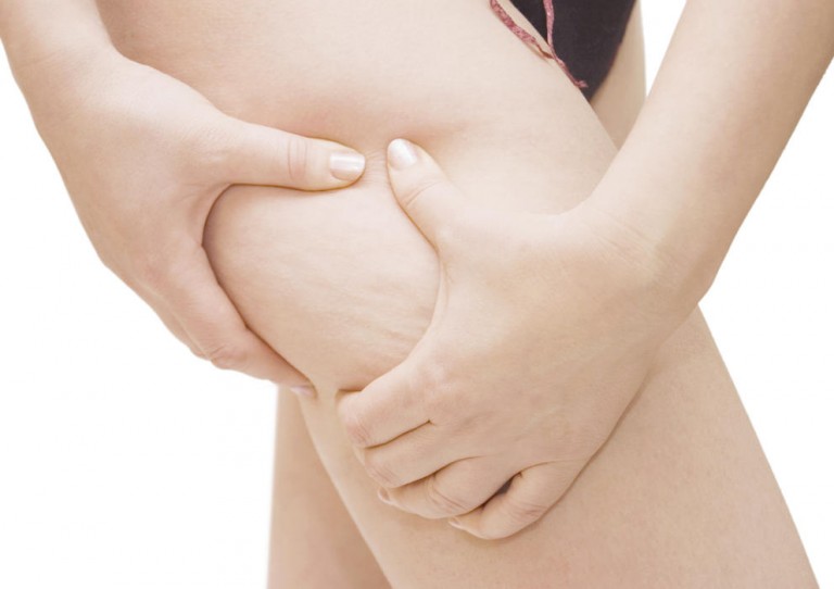 Eliminar la celulitis de forma natural