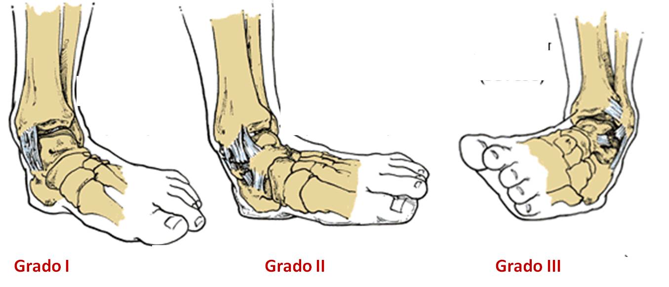 esguince tobillo grados