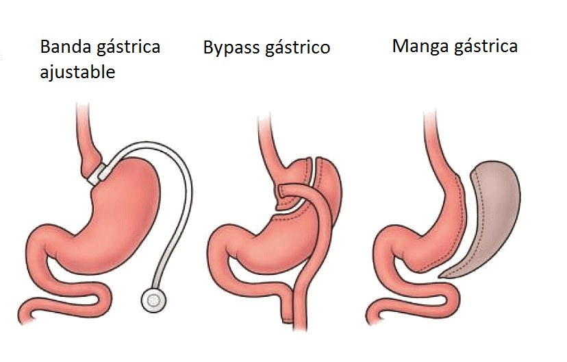 Bariátrica 2