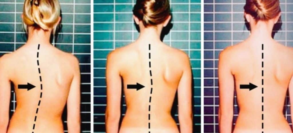 deformaciones de la columna