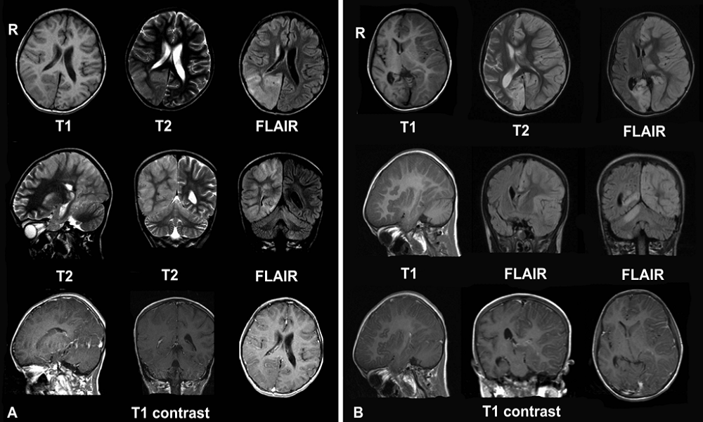 epilepsia, salud