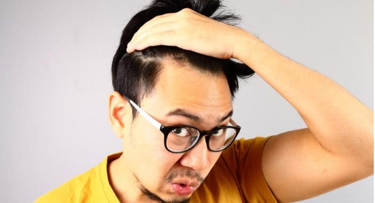 síntomas de alopecia areata
