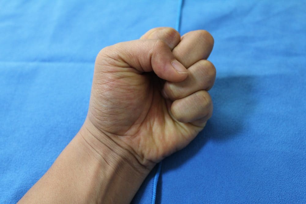 Tratamiento para la muñeca abierta