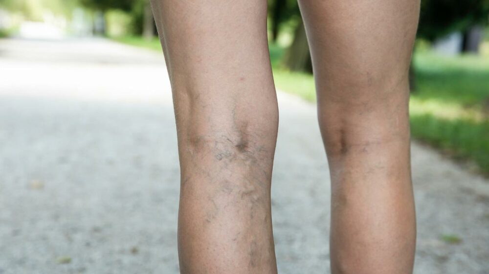 qué son las varices