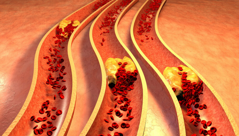 La obstrucción de las arterias provoca fallos cardíacos y cerebrales
