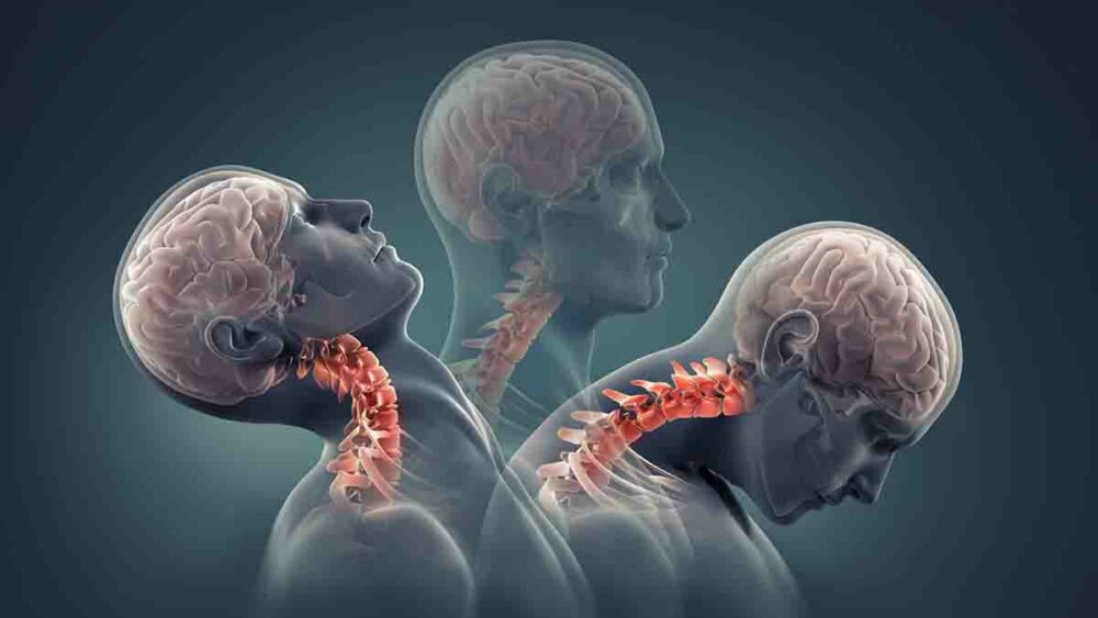 recuperarse de un latigazo cervical