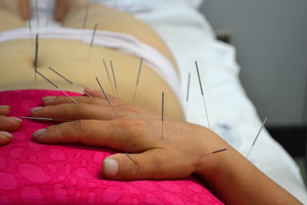 acupuntura en el tratamiento del dolor y lesiones musculares