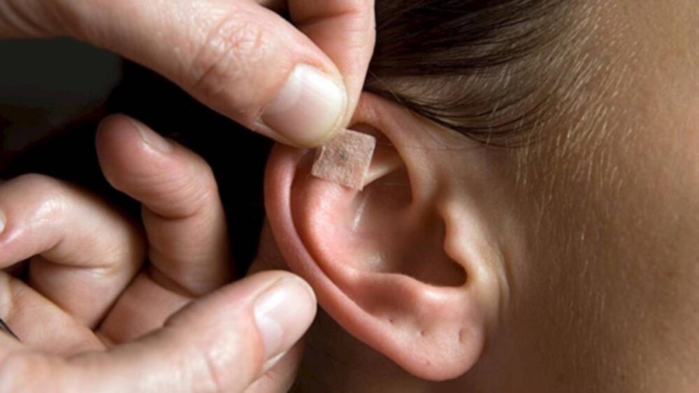 auriculoterapia