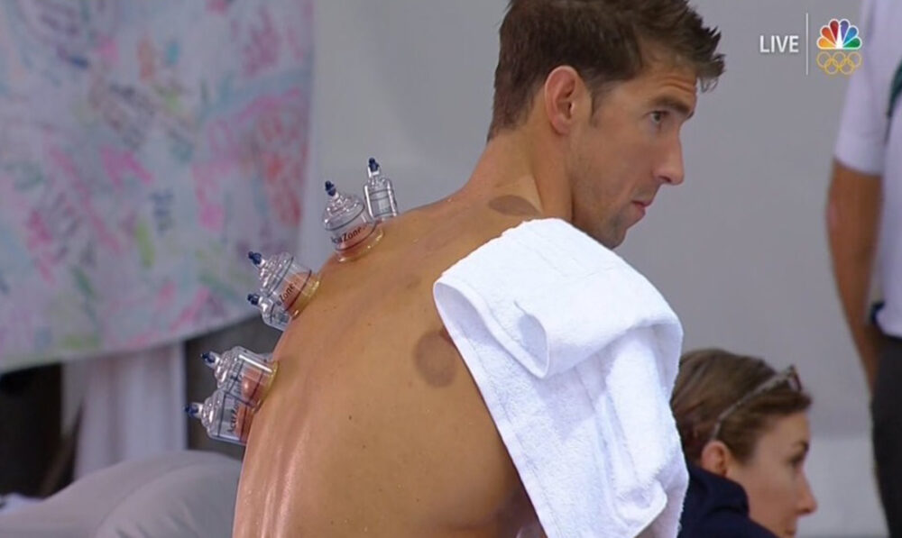 Vacuterapia Michael Phelps