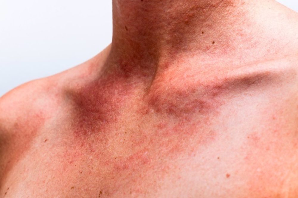 alergia al sol síntomas