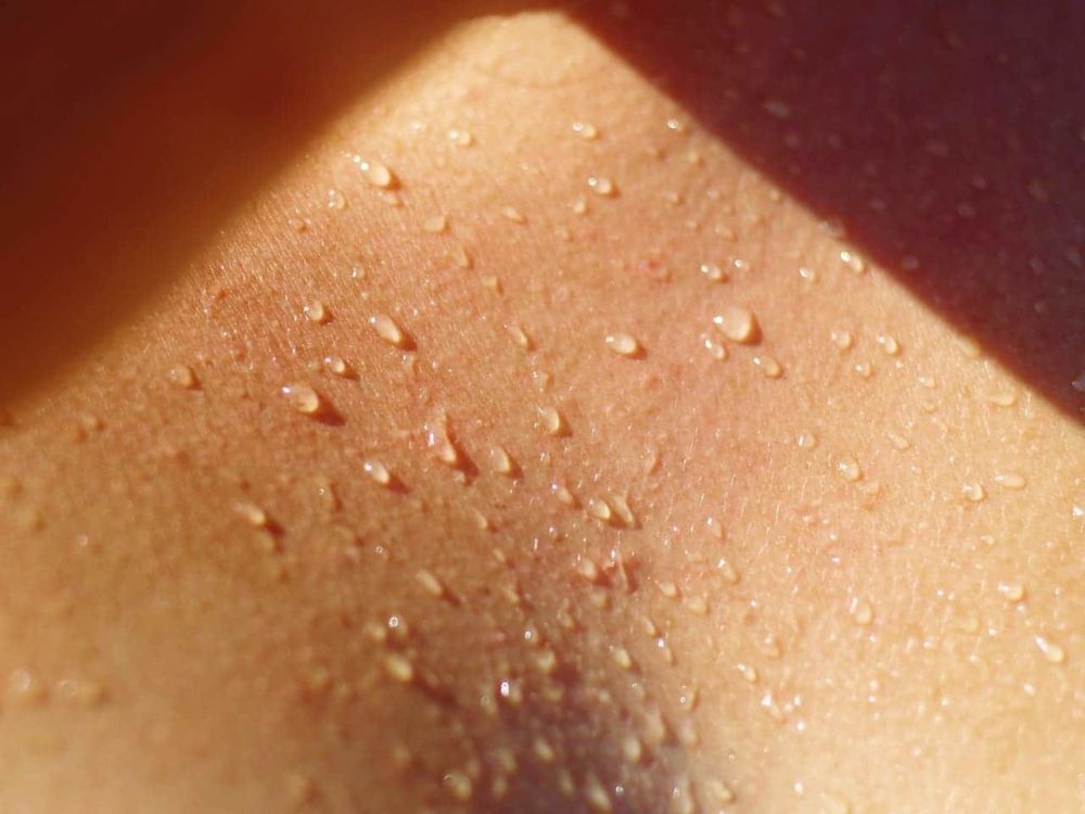 alergia al sol síntomas